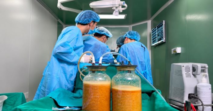 Bác sĩ phẫu thuật lấy gần 5 lít dịch và chất lạ trong ngực nữ bệnh nhân sau biến chứng tiêm chất làm đầy, cảnh báo nguy cơ làm đẹp thiếu an toàn.