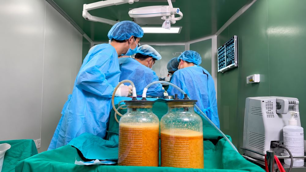 Bác sĩ phẫu thuật lấy gần 5 lít dịch và chất lạ trong ngực nữ bệnh nhân sau biến chứng tiêm chất làm đầy, cảnh báo nguy cơ làm đẹp thiếu an toàn.