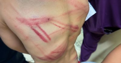 Cha dùng ống nhựa đánh con trai 9 tuổi đến bầm tím khắp người