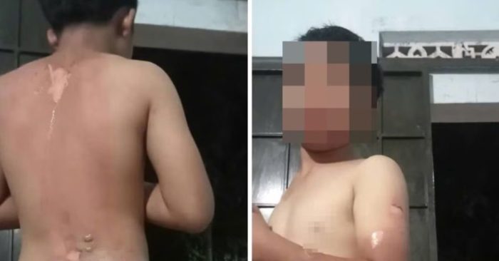 Công an xác minh bé trai ở Đắk Lắk nghi bị mẹ tạt nước sôi