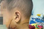 6 trẻ nhập viện vì chó cắn chỉ trong một tháng đầu hè