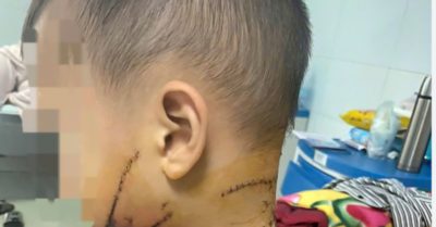 6 trẻ nhập viện vì chó cắn chỉ trong một tháng đầu hè
