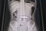 Bé gái năm tuổi nuốt thỏi vàng, bệnh viện phải phẫu thuật gắp ra