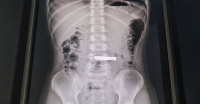 Bé gái năm tuổi nuốt thỏi vàng, bệnh viện phải phẫu thuật gắp ra