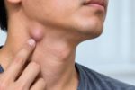 Nhận biết 4 dấu hiệu bất thường khi nổi hạch ở cổ