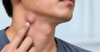 Nhận biết 4 dấu hiệu bất thường khi nổi hạch ở cổ