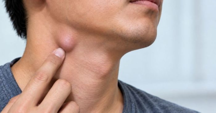 4 dấu hiệu cảnh báo hạch ở cổ là bất thường, giúp nhận biết khi nào tình trạng sưng hạch cần được lưu ý.